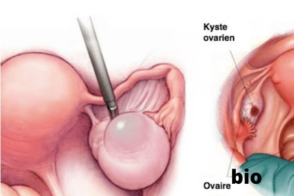 Le clou de girofle un puissant nettoyeur de kyste ovarien