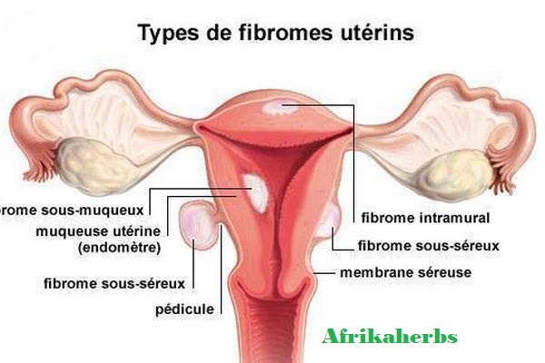 Quelles sont les causes des fibromes et myomes