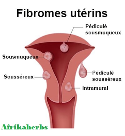 Qu’est-ce que les fibromes et myomes