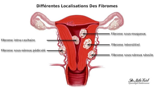 Fibrome et grossesse traitement naturel