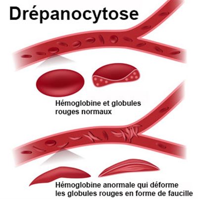 Qu’est ce que la drépanocytose