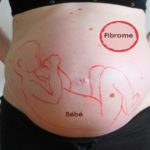 fibrome et grossesse traitement naturel*