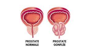 traitement prostate plante