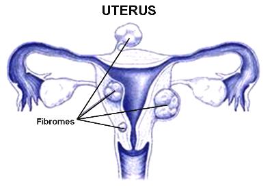 Traitement naturel utérus myomateux
