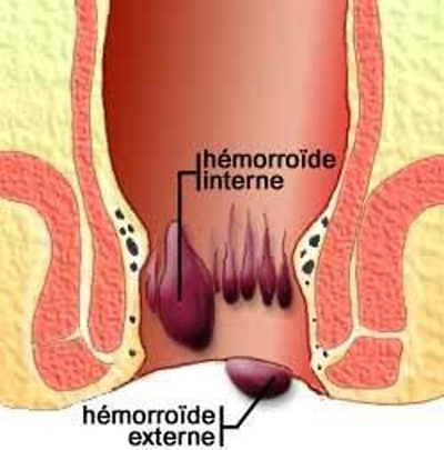 Comment soigner naturellement les hémorroïdes