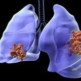 Meilleur traitement naturel pour un cancer de poumon