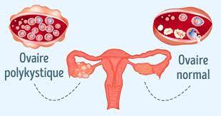 Comment traiter naturellement le syndrome des ovaires polykystiques?